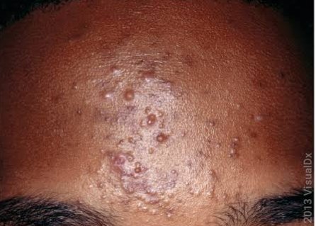 Rosacea