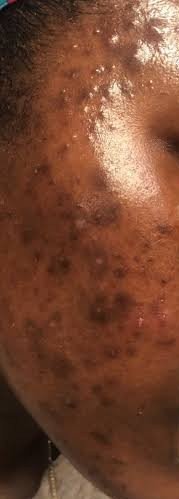 Sunspot hyperpigmentation