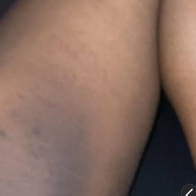 Dark Inner Thighs