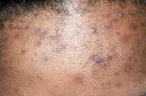 Dark Spots